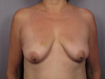Breast Lift / Breast Augmentation