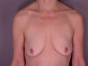 Breast Lift / Breast Augmentation
