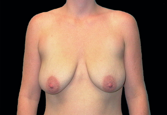 Breast augmentation