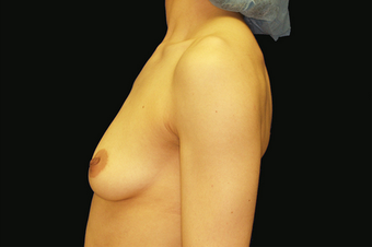 Breast Augmentation with mastoplexy