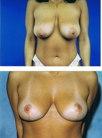Mastopexy (breastlift) front view