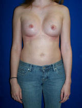 Pectus Excavatum Surgery