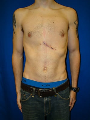 Pectus Excavatum, Chest Wall Reconstruction Surgery