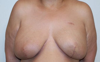 Breast Reconstruction