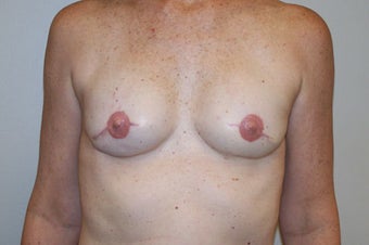Bilateral mastectomy with reconstruction with 2-stage tissue expander/permanent implant technique