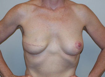 Breast Reconstruction