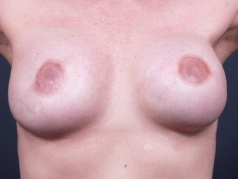 38 Year Old for Breast Reconstruction
