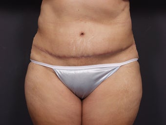 Post Tram Flap Abdomen - 46 Year Old Female for Breast Reconstruction