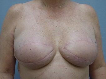 Breast Reconstruction