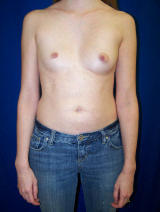 Pectus Excavatum Surgery