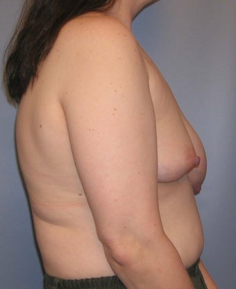 Reconstruction for Problem Breasts