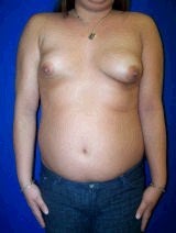 Breast Reconstruction Surgery