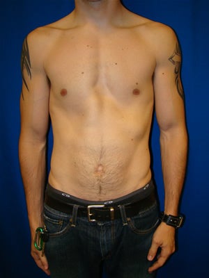 Pectus Excavatum, Chest Wall Reconstruction Surgery