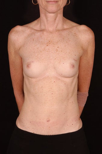 Breast Reconstruction
