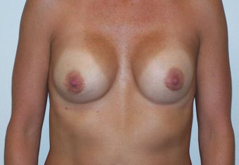 Breast Reconstruction