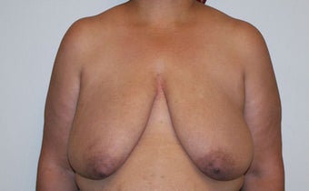 Breast Reconstruction