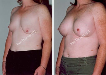 Breast Reconstruction