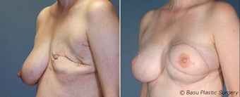 Breast reconstruction