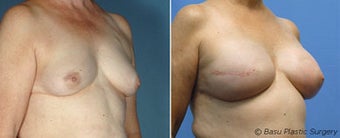 Breast reconstruction
