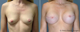 Breast reconstruction