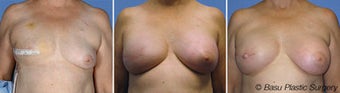 Breast reconstruction