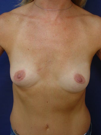 Breast Reconstruction