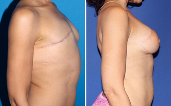 Breast Reconstruction