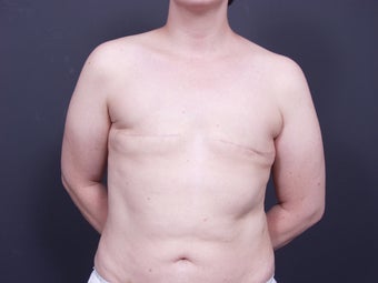 37 Year Old Female for Breast Reconstruction