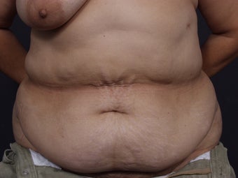 Post Tram Flap Abdomen - 46 Year Old Female for Breast Reconstruction