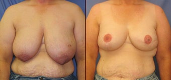 Breast Reconstruction