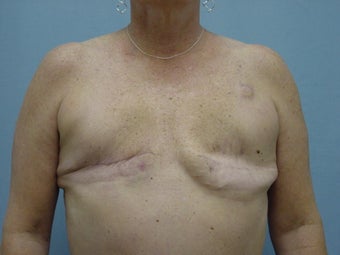 Breast Reconstruction