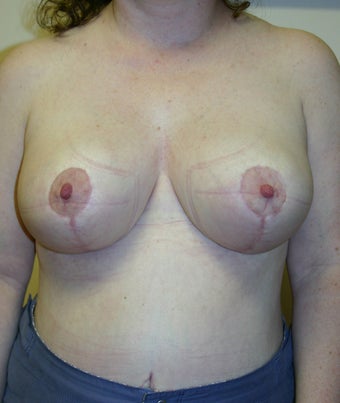 Breast reduction before and after, vertical short scar technique 