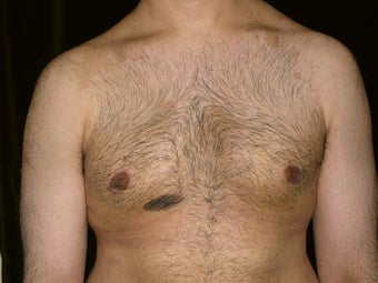 Male Breast Reduction