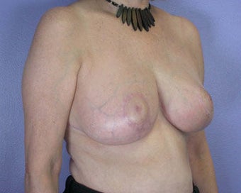 Breast Reduction