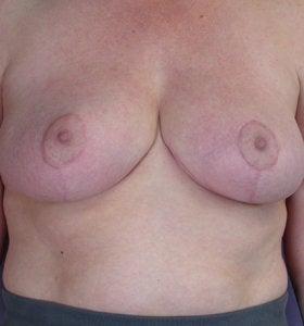 Breast Reduction