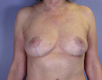 Breast Reduction