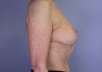 Breast Reduction