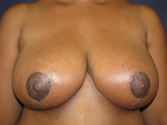 Breast Reduction