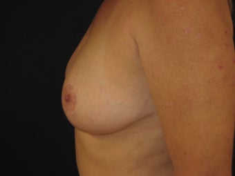 Breast Reduction