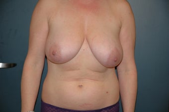 Breast reduction and lift