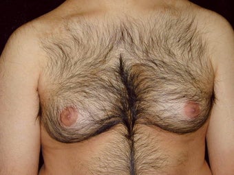 Male Breast Reduction