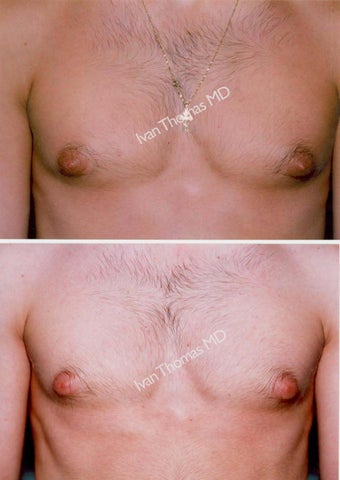 Male Breast reduction-Gynecomastia