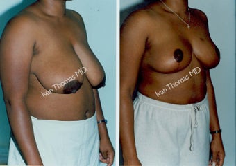 Breast Reduction