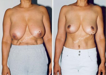 Breast Reduction