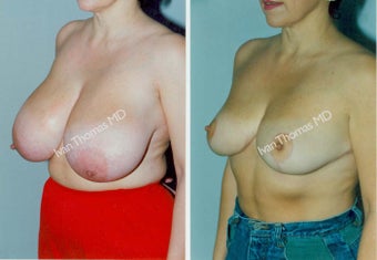 Breast Reduction