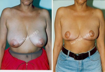 Breast Reduction
