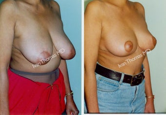 Breast Reduction