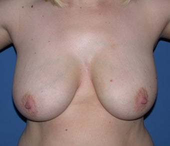 Breast reduction