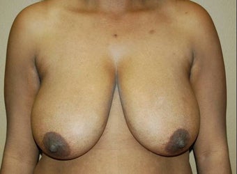 Breast reduction