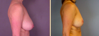 Breast Reduction
